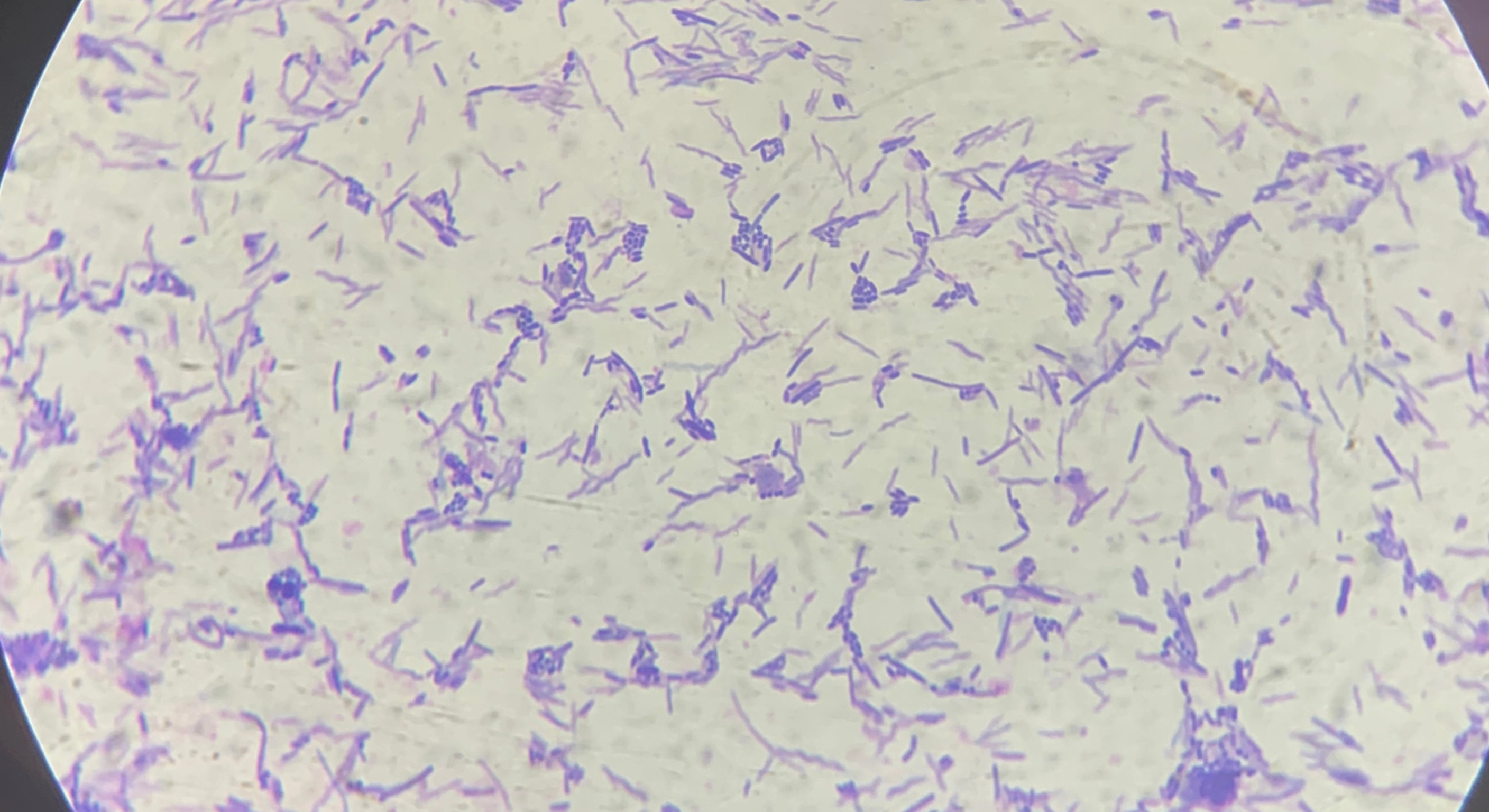 Chronic Diarrheal and Microscopics Colitis Syndromes