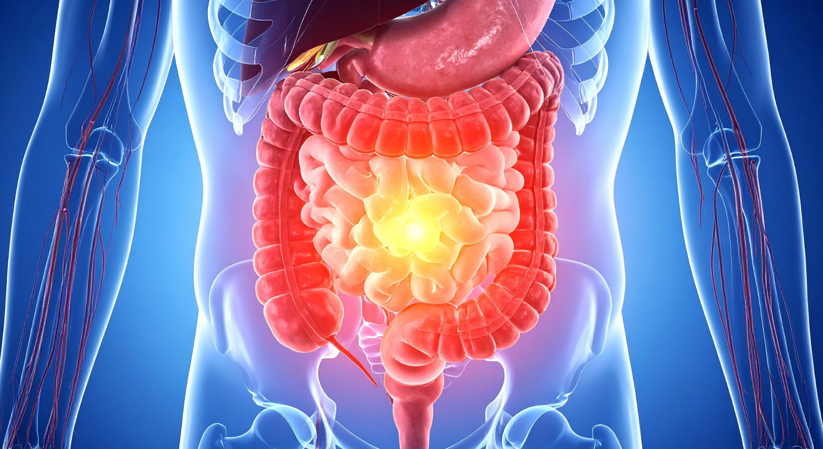 Inflammatory Bowel Disease
